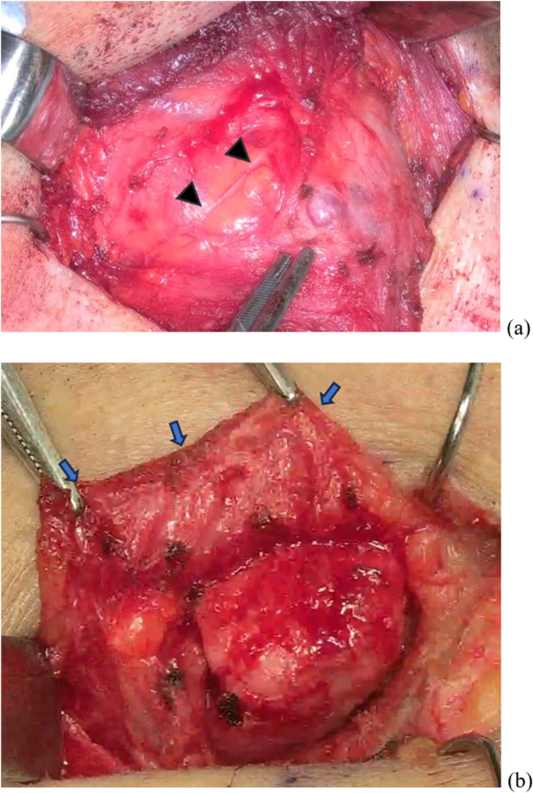 Enhancing submandibular gland resection: A retrospective study on the efficacy of the ORBEYE 3D exoscope.