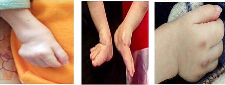 Infantile systemic Hyalinosis in a 6-month-old male: identification of homozygous ANTXR2 gene mutation.