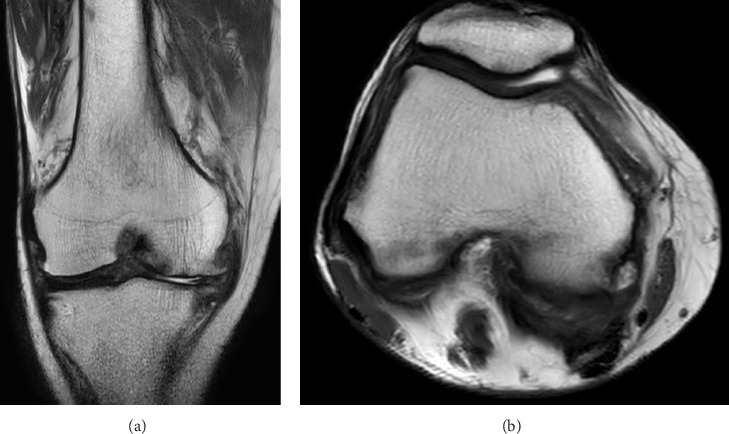 Successful Treatment of Leukemic Synovitis Complicated With Chronic Myelomonocytic Leukemia.