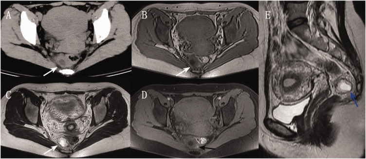 Retroperitoneal ectopic pregnancy localized to the mesorectum: A case report and mini-review of literature.