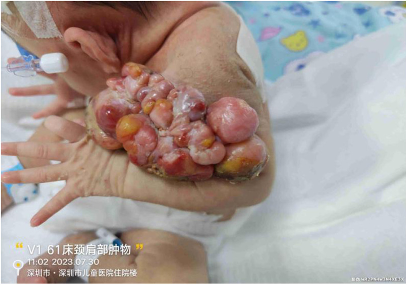 Case Report: Multidisciplinary management and nursing care for a preterm infant with rare extrarenal malignant rhabdoid tumor: a clinical case study.