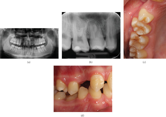 Combining a Sinus Augmentation With Tooth Transplantation When Replacing a Missing Premolar in a Young Patient.