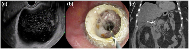 EUS-guided gallbladder drainage versus percutaneous gallbladder drainage in high-risk patients with acute cholecystitis: a propensity score-matched analysis.