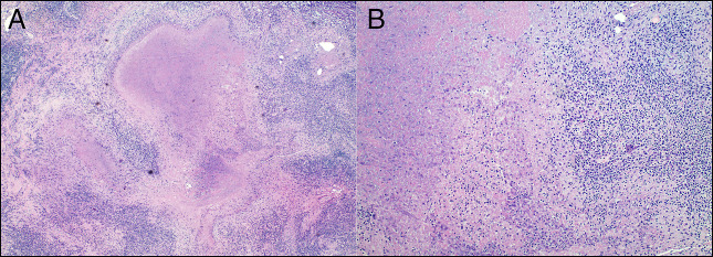 Brucellosis. A Rare Cause of Biliary Dysplasia and Ampullary Adenocarcinoma?