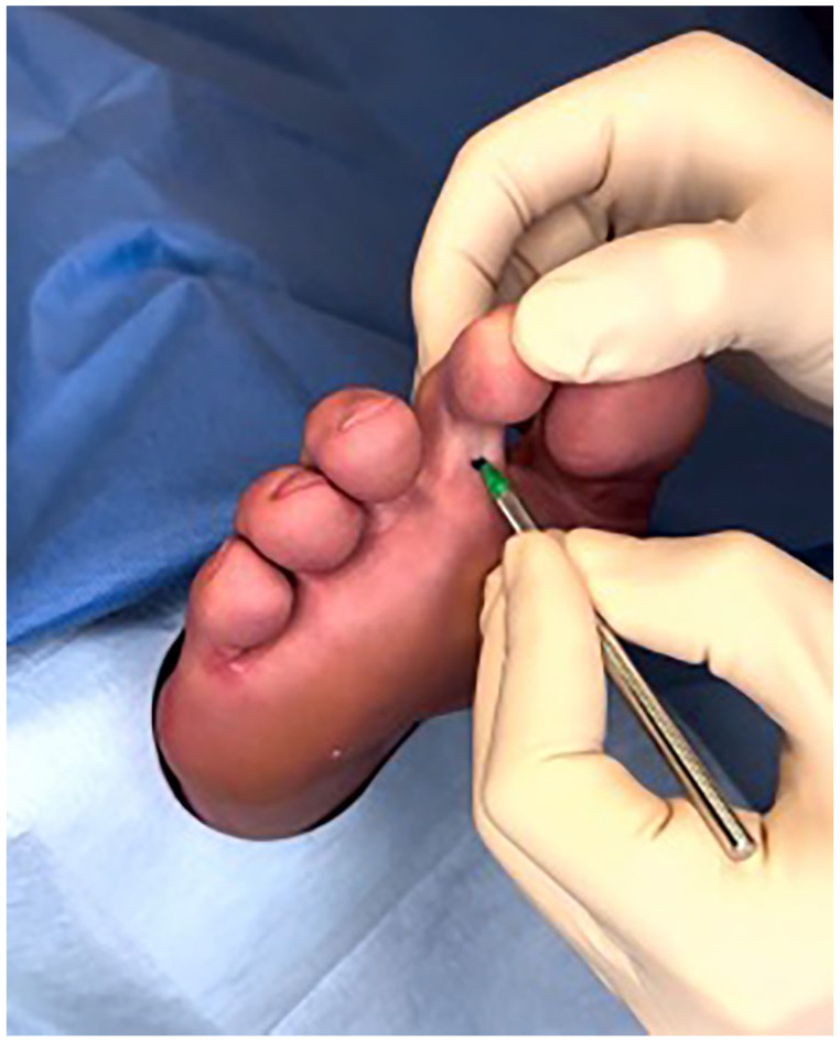 Minimally Invasive Plantar Capsule Release and Flexor Tenotomy for Rigid Diabetic Hammer Toe: A Technique Tip.