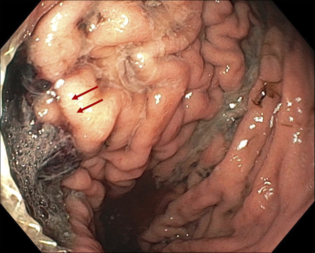 Lumen-Apposing Metal Stent Bleeding Risk: Management of Splenic Artery Erosion.