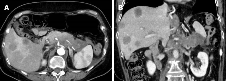 Transpapillary drainage of pancreatic fluid leakage <i>via</i> a rigid trans-tumoral tract using a drill dilator: A case report.