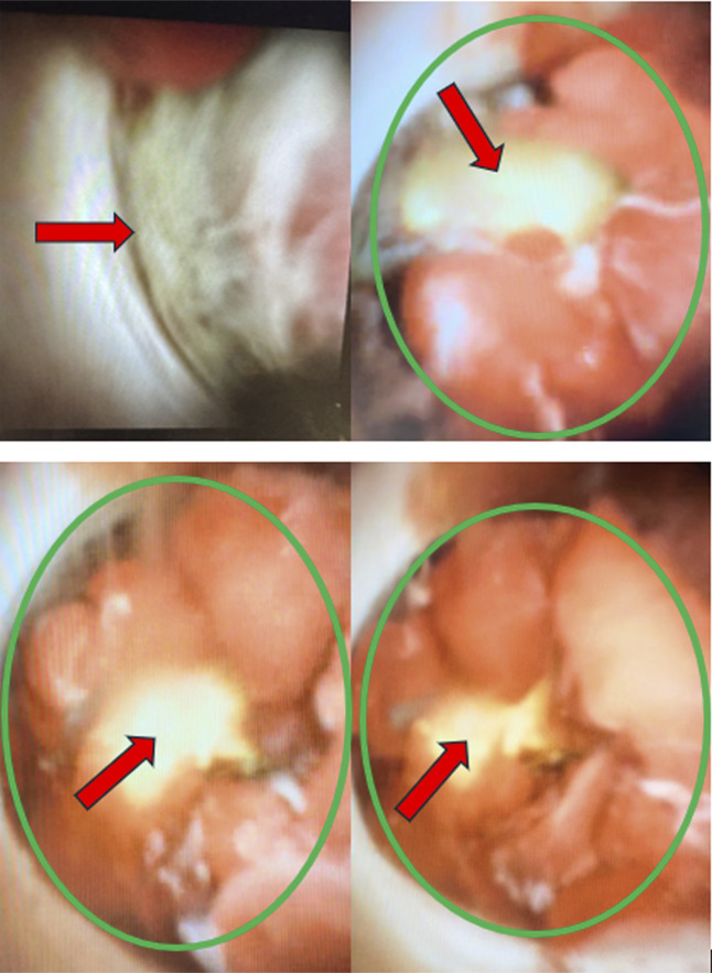 Diagnosis of Perihilar Osteoclast Giant Cell Carcinoma in an Elderly Patient: A Report of Diagnostic Challenges Over Several Attempts.