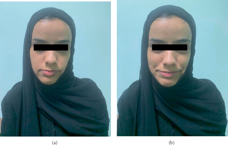 Urofacial Syndrome, an Expressive and Unmasking Sign of Voiding Dysfunction: Case Report and Review of the Literature.