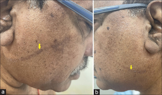 Bilateral Hyperpigmented Linear Streaks on The Face: An Unusual Presentation of Allergic Contact Dermatitis.