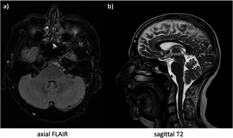 MRI-negative cerebellar syndrome caused by medication-induced magnesium deficiency: a case report.