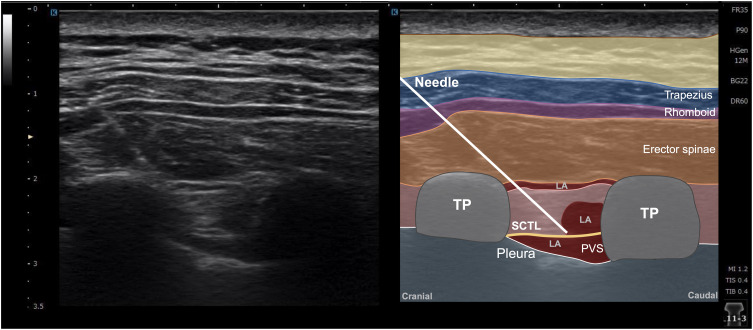 Single- versus Multiple-Injection Intertransverse Process Block for VATS: A Randomized Trial on Dermatomal Sensory Blockade.