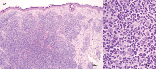 Solitary Facial Nodule in a Young Female Patient: A Quiz.