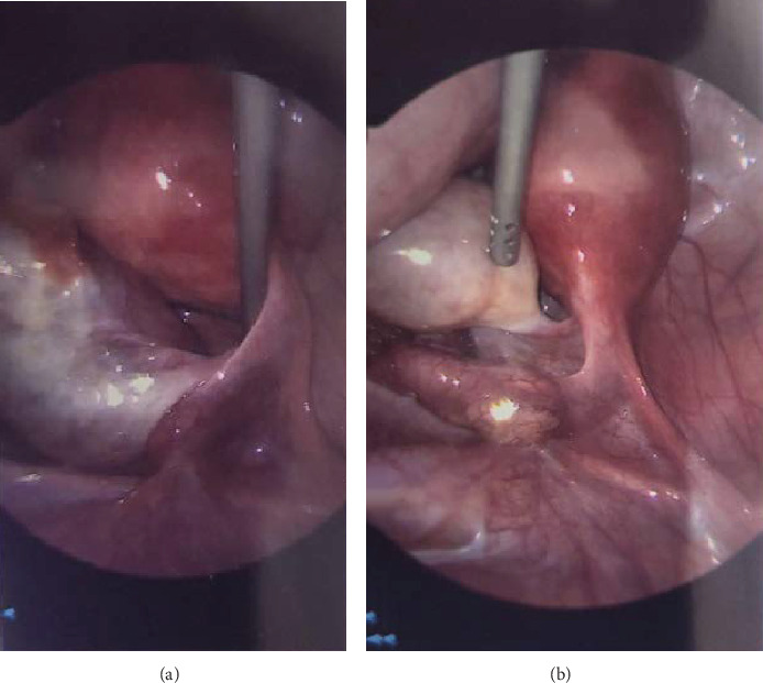 Ovarian Torsion in Normal Ovaries in Reproductive-Aged Women.