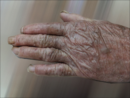 Huriez Syndrome.