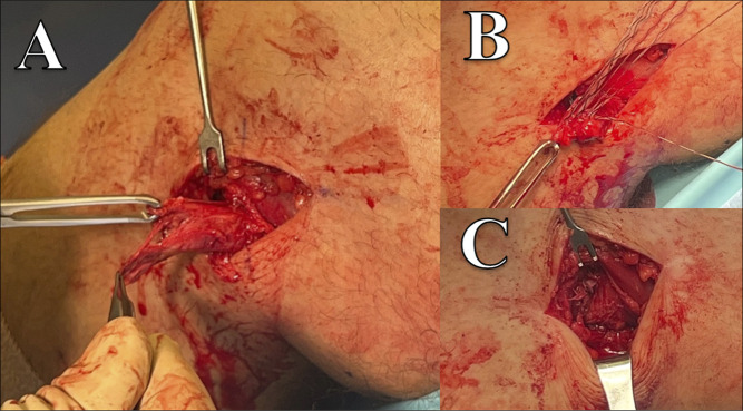 Distal Hamstring Injuries and Disorders.