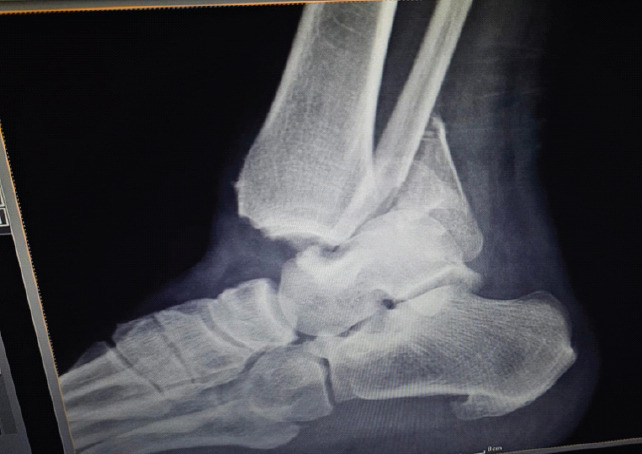 Single-Stage Hybrid Fixation of a Grade III Open, Unstable Trimalleolar Ankle Fracture with Syndesmotic Disruption and Posterior Talar Subluxation.