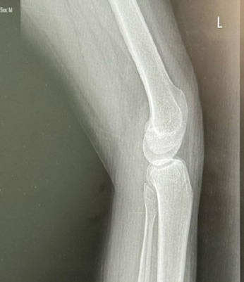 Congenital Absence of Bilateral Patella in an Active Military Personnel Case Report.