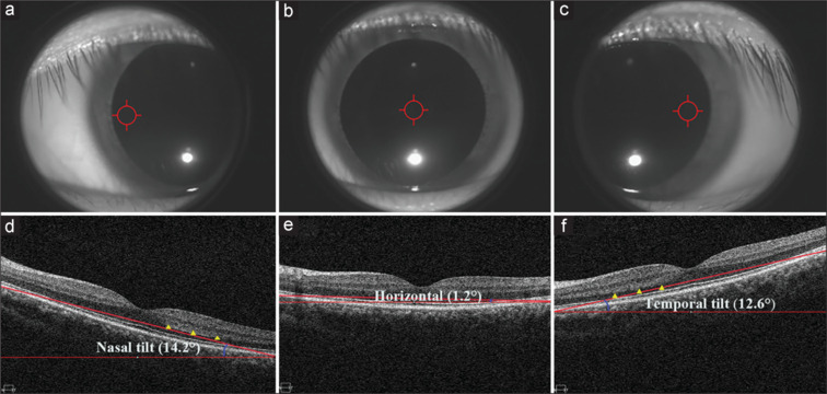 Effect of nasal and temporal scanning tilt on whole and local macular vessel density measurement using OCTA.