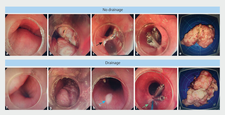 Preventive wound drainage reduces esophageal fistula or infection after endoscopic resection of giant submucosal tumors in the esophagus.