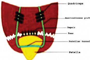Successful Management of Quadriceps Tendon Tear with Repair and Augmented with Semitendinosus Graft -A Case Series.