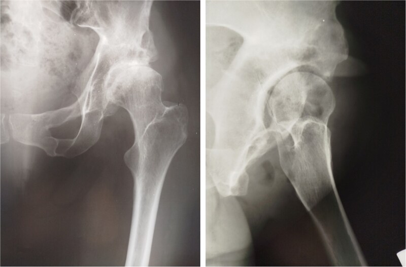 Hybrid total hip arthroplasty 28 years after Pol Le Cœur triple pelvic osteotomy used for the treatment of developmental dysplasia of the hip: a case report.