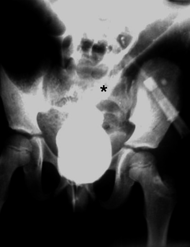 Colonic Volvulus Associated with Hirschsprung's Disease in the Pediatric Age.