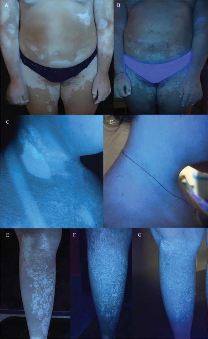 JAK Inhibitors in Down Syndrome: Alopecia Areata Resolution and Vitiligo Improvement with Baricitinib.