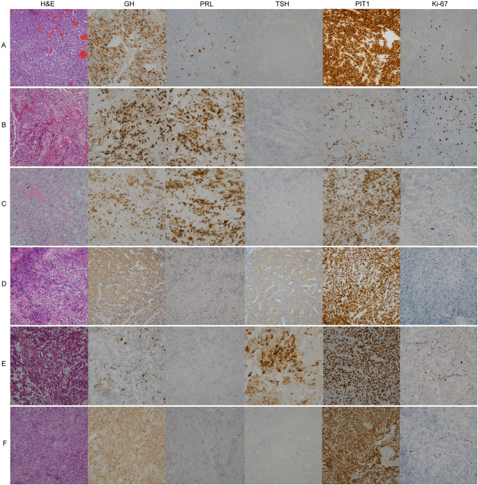 Silent growth hormone pituitary adenomas: a single-center study.