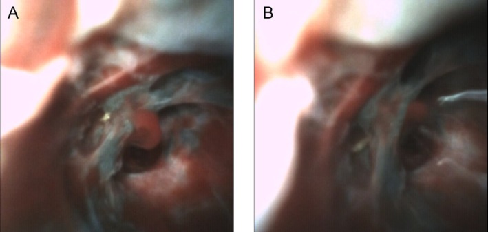 Direct Intranodal Visualization During EBUS-TBNA Using the Iriscope: A Novel Case Series.