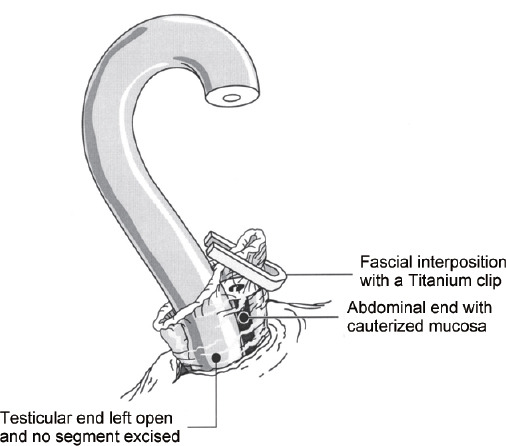 Occlusive effectiveness of open-ended no-scalpel vasectomy with mucosal cautery and fascial interposition: a descriptive study.
