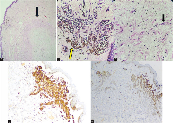 Neuroid Overgrowth Proliferative Nodule in Congenital Melanocytic Nevus: A Rare Occurrence.