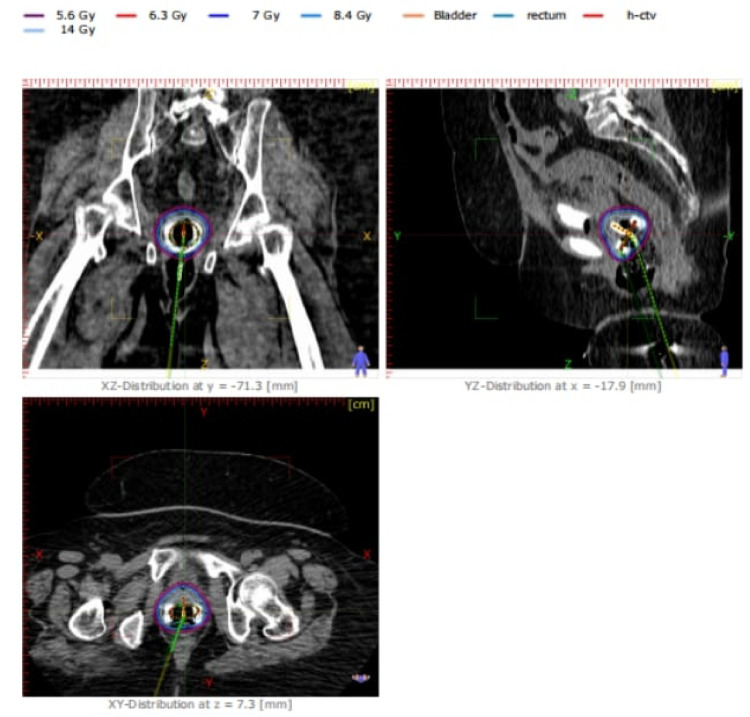 Dosimetry evaluation and uncertainty analysis of Cobalt-60 HDR brachytherapy for cervical cancer in resource-limited settings.