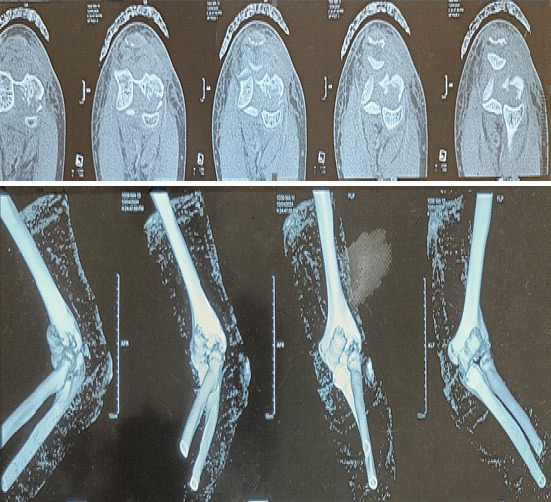 Capitellum Fracture with Distal Triceps Tendon Avulsion Injury: A Rare Presentation with Literature Review.