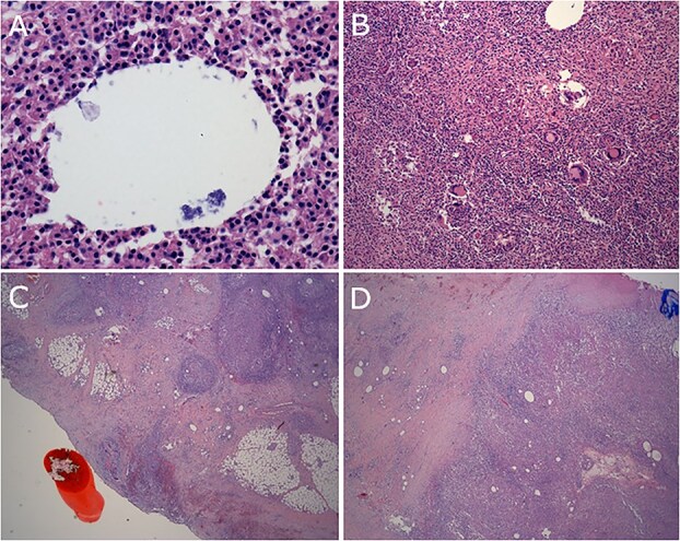 Peritonectomy for disseminated peritoneal implantation after dermoid cyst spillage causing recurrent peritonitis and xanthogranulomatous reaction: a case report.