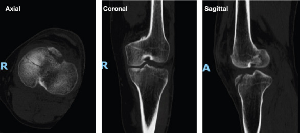 Anteromedial Tibia Plateau Fracture without Significant Ligamentous Injury Treated Successfully with Open Reduction and Internal Fixation: A Case Report.
