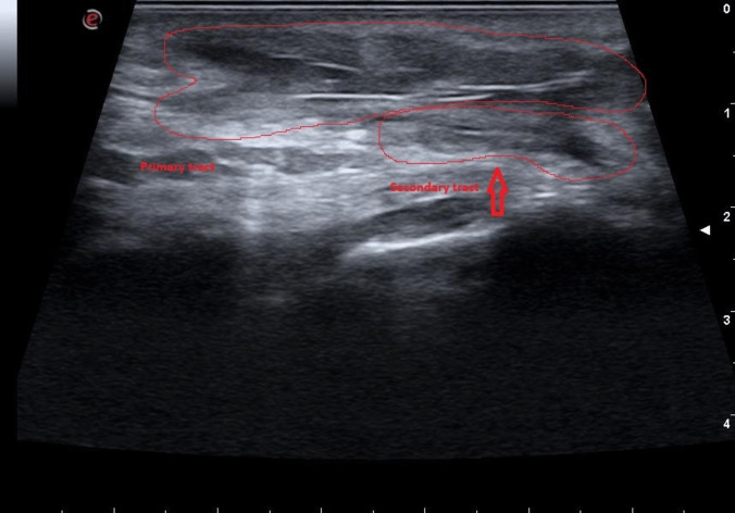 Intra-operative ultrasound in the surgical treatment of complex and recurrent pilonidal disease: a retrospective, observational, single-center study.