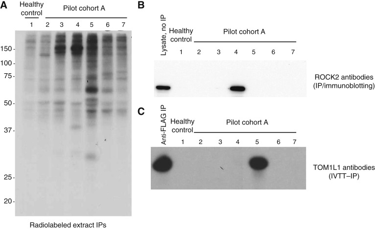 Novel Pretreatment Autoantibodies Correlate with Enfortumab Vedotin-Related Dermatologic Events in Patients with Advanced Urothelial Cancer.
