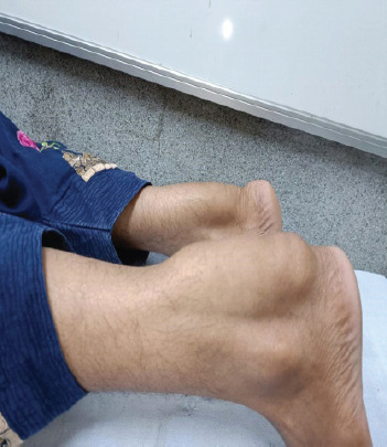 Bilateral Tendoachilles Xanthoma in a Young Female: A Rare Case Report.