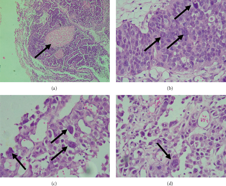 Unusual Type of Acinar Adenocarcinoma of the Prostate With Low PSA: A Histopathological Report of Two Cases of Pleomorphic Giant Cell Adenocarcinoma.