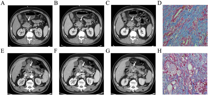 CT-based radiomics models decode fibrosis content and molecular differences in pancreatic ductal adenocarcinoma: a multi-institutional study.
