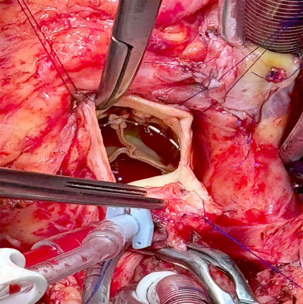 Successful Aortic Valve Replacement After Transcatheter Aortic Valve Implantation (TAVI) Following Initial Surgical Aortic Valve Replacement (SAVR): A Case Report.