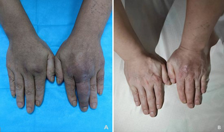 Recurrent Subcutaneous Abscess from Co-Infection with <i>Prototheca wickerhamii</i> and <i>Mycobacterium haemophilum</i>: mNGS Misdiagnosis as Leprosy.