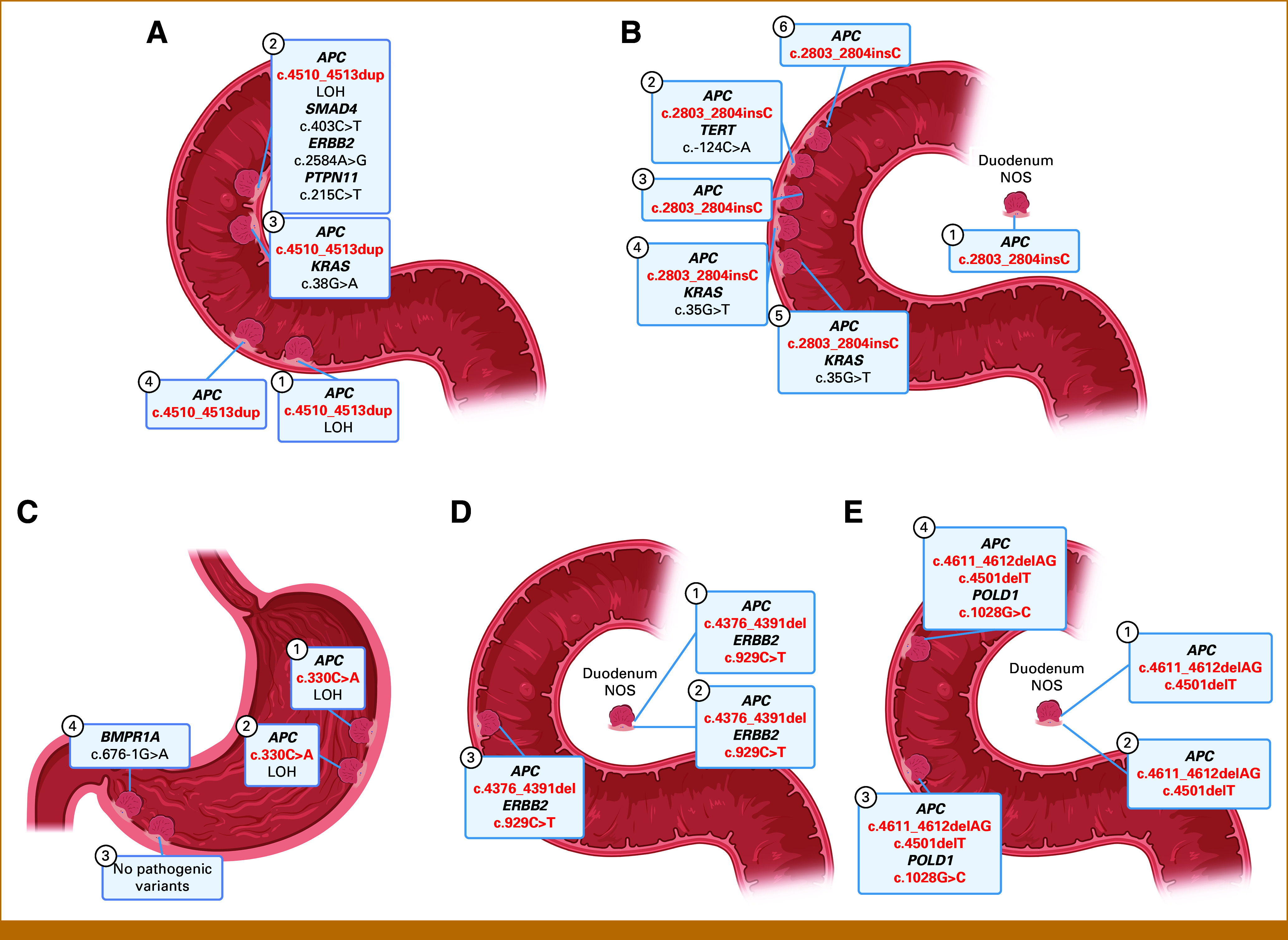 Exploring <i>APC</i> Mosaicism in Upper Intestinal Tract Adenomas.