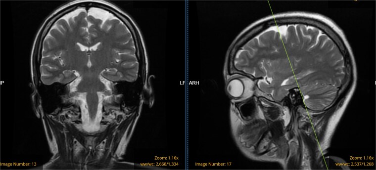 New-onset seizure In Peripartum period: a case of Sjögren's syndrome with renal artery stenosis.