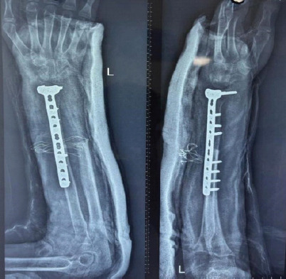 A Novel, Joint Sparing Surgical Approach to the Management of Giant Cell Tumor of the Distal Radius in a Pediatric Patient: A Case Report and Comprehensive Literature Review.