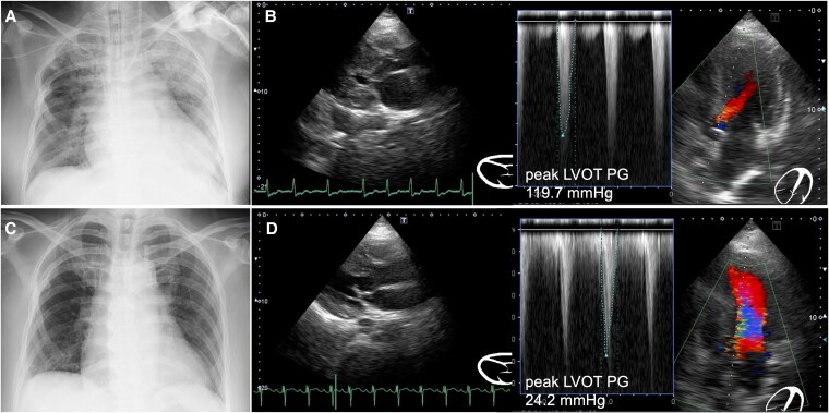 Rescue percutaneous transluminal septal myocardial ablation for difficult ventilator weaning in drug-resistant hypertrophic obstructive cardiomyopathy: a case report.