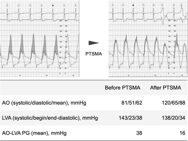 Rescue percutaneous transluminal septal myocardial ablation for difficult ventilator weaning in drug-resistant hypertrophic obstructive cardiomyopathy: a case report.