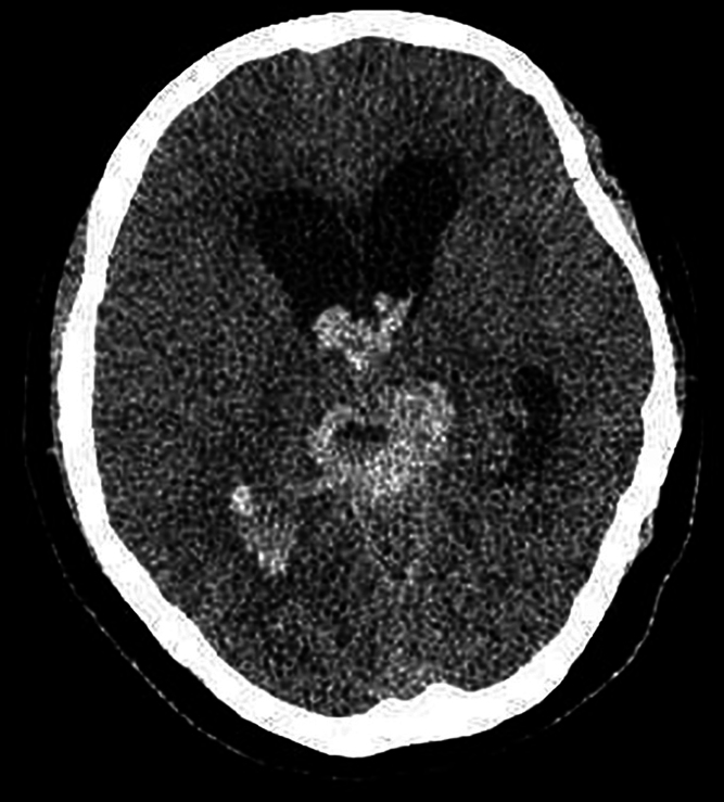 Primary malignant melanoma of the pineal region: illustrative case.