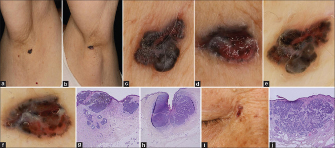 Bilateral Axillary Basal Cell Carcinoma.